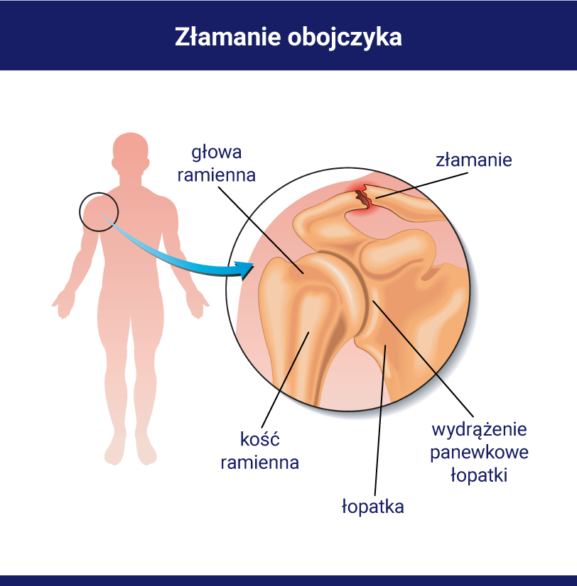 złamanie obojczyka